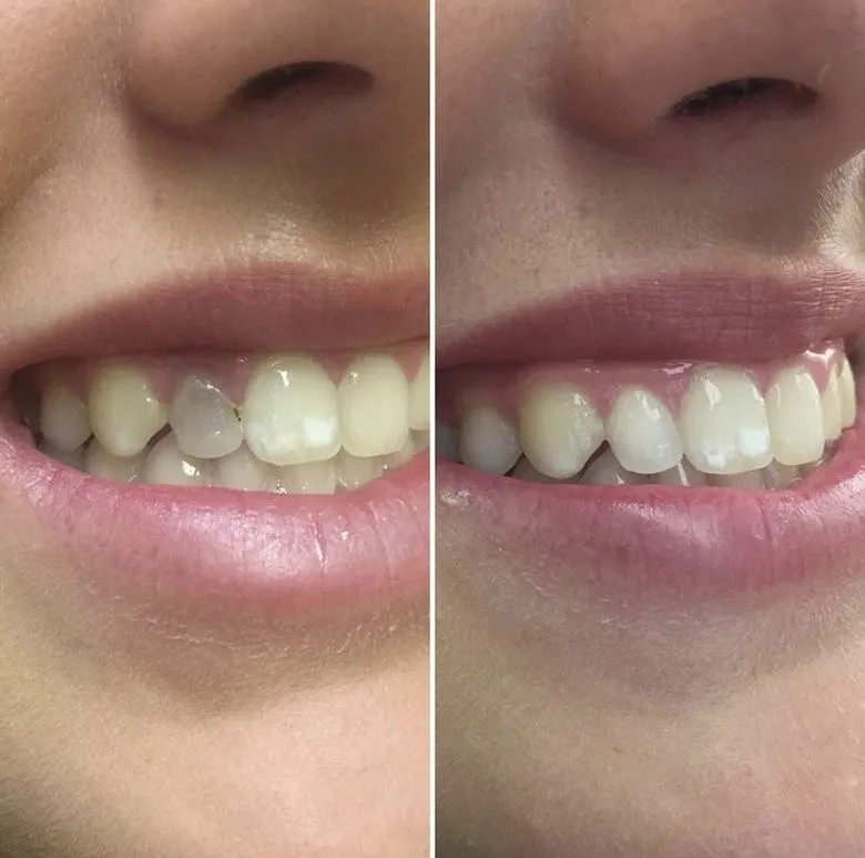 tooth bleaching case study